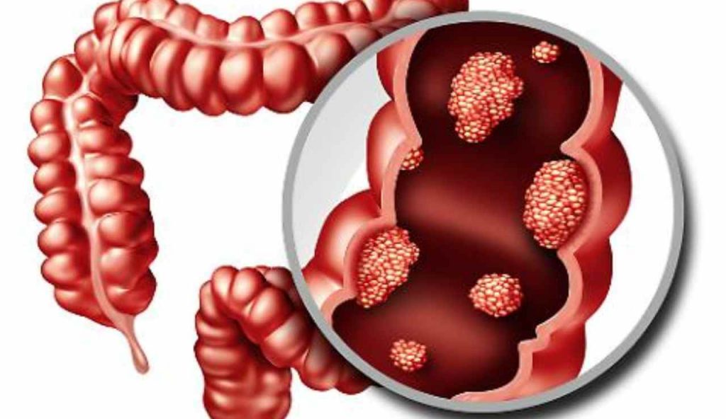 Tumore all’intestino, chi mangia questo cibo lo previene | Gli scienziati non hanno parole